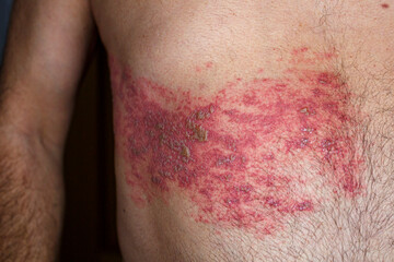 Skin lesion symptom in Shingles or Herpes zoster in human. Shingles or Herpes zoster is aviral disease caused by varicella zoster virus charatrized by a painful skin rash with blisters on the body.