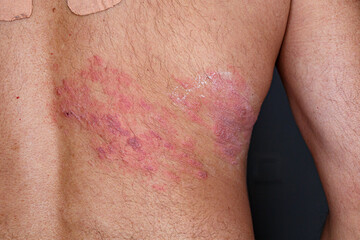 Skin lesion symptom in Shingles or Herpes zoster in human. Shingles or Herpes zoster is aviral disease caused by varicella zoster virus charatrized by a painful skin rash with blisters on the body.