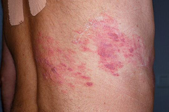 Skin lesion symptom in Shingles or Herpes zoster in human. Shingles or Herpes zoster is aviral disease caused by varicella zoster virus charatrized by a painful skin rash with blisters on the body.