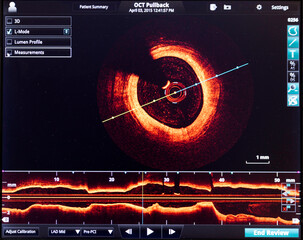 Intravascular optical coherence tomography oct image angiography catheter lab atherosclerosis....