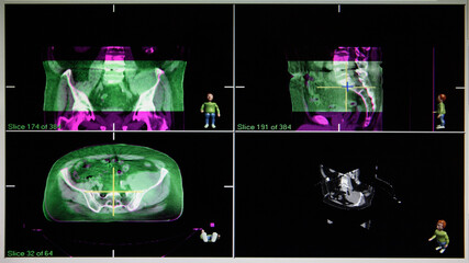 radiation oncology beam field imaging - technical imaging in radiation therapy, radiation shooting...
