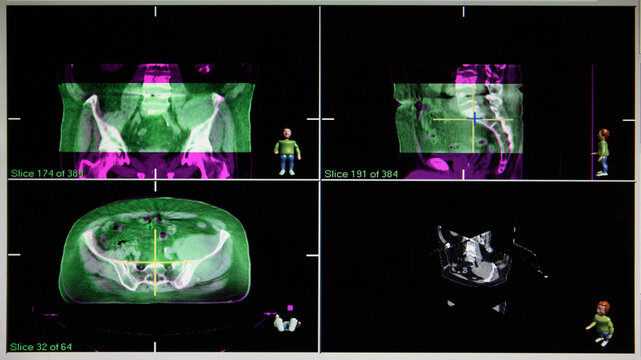 radiation oncology beam field imaging - technical imaging in radiation therapy, radiation shooting point
