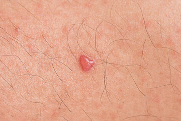 Red blister bleb on skin close up.