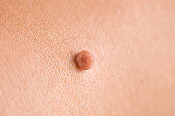Skin tag or acrochordon or soft fibrom dermatology problem on skin concept. - obrazy, fototapety, plakaty