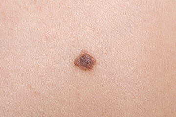 melanocyte, young, man, close up, blemish, removal, woman, black, body, cosmetic, patient,...