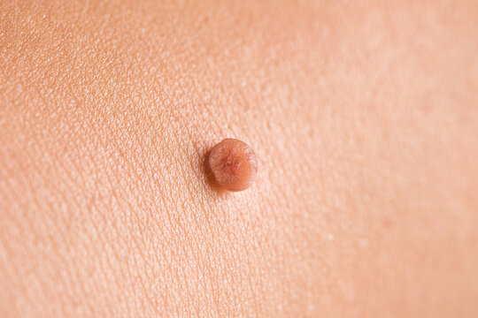 Skin Tag Or Acrochordon Or Soft Fibroma Or Mole In Male Back