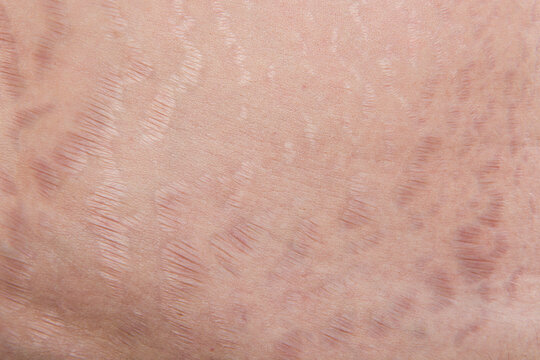 stretch marks and scars, striae gravidarum
