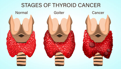 Set with illustration of healthy and diseased thyroid on light background. Stages of development...