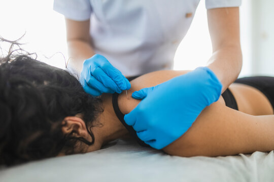 Woman getting acupuncture treatment in salon