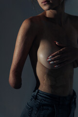 Beautiful young woman with amputee arm and scars from burn on her body poses topless.