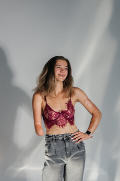 Smiling Young Woman With Amputee Arm And Scars From Burn On Her Body Poses In Lacy Bra.