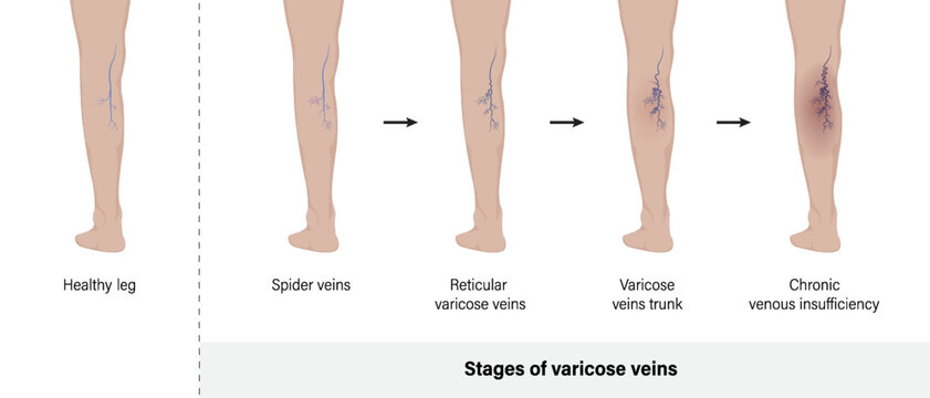 Stage of varicose veins. Varicose veins in the human leg vector.