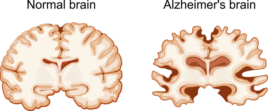 Normal brain and Alzheimer's brain