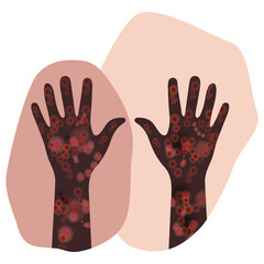 Painful rash on both arms with dark brown skin tone. Symptoms of patient with meningitis.  Disease manifestation signs. Derma condition design. Irritation, monkeypox virus, dermatitis and drug allergy
