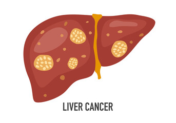 Liver cancer disease concept vector illustration on white background.