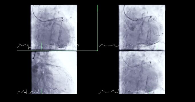 Coronary angiogram of coronary artery during cardiac catheterization  in cardiac catheterization laboratory.