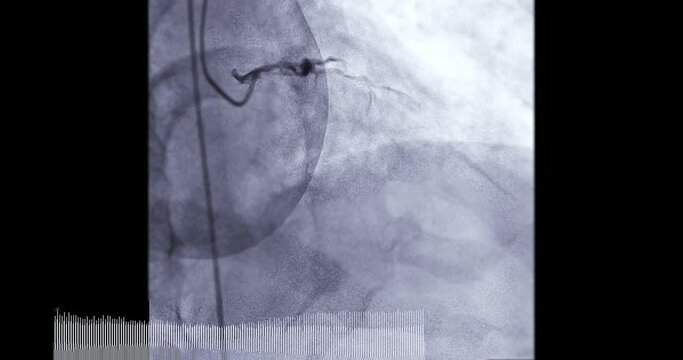 Coronary angiogram of coronary artery during cardiac catheterization  in cardiac catheterization laboratory.