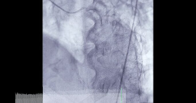 Coronary angiogram of coronary artery during cardiac catheterization  in cardiac catheterization laboratory.