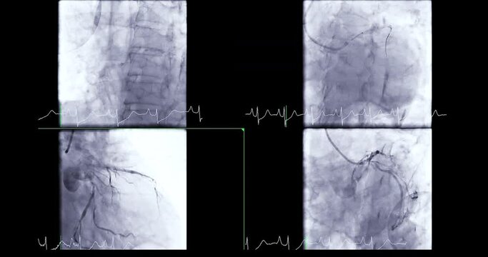 Coronary angiogram of coronary artery during cardiac catheterization  in cardiac catheterization laboratory.