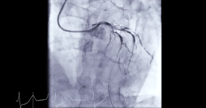 Coronary angiogram of coronary artery during cardiac catheterization  in cardiac catheterization laboratory.