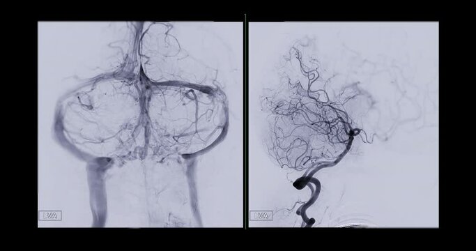 Cerebral angiogram  for diagnosis abnormalities such as cerebral artery aneurysms and cerebral artery disease such as atherosclerosis (plaque).