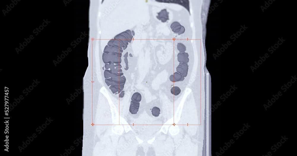 Poster ct colonography or ct scan of large intestine 3d rendering on the screen for diagnosis large bowel c