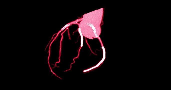 CTA Coronary artery 3D rendering image s detect coronary artery disease from CT Scanner.