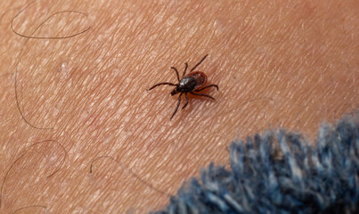 The parasite mite sits on a persons skin. infection carrier. Ixodes ricinus