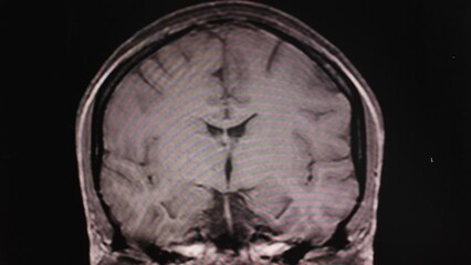 Medical exam of human brain. MRI scanning. Magnetic resonance imaging. Alzheimer disease. Shot from hospital monitors. Normal anatomy. Diagnosis medical data. medical equipment. 4 k video