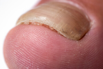Close up image of a finger with nail fungus infection © eliosdnepr