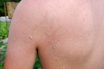 The man received sunburn on the seashore. The skin peels off. Protection of the skin from the sun.