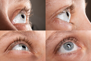 woman eye with corneal dystrophy, keratoconus, thinning of the cornea