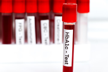 HbA1c test from blood , Blood samples to be analyzed in the laboratory
