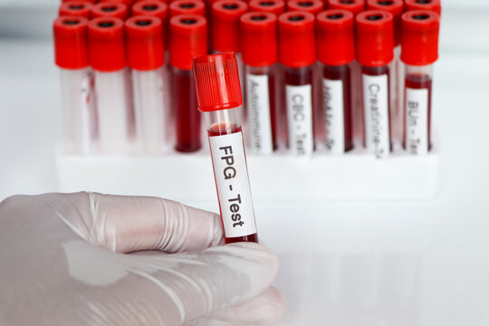 FPG-test from blood , Blood samples to be analyzed in the laboratory
