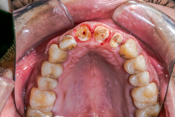 Occlusal view of maxillary arch with unhealthy decayed anterior teeth with caries on the incisors. Indirect view with dental mirror, lips and cheeks retracted with cheek retractor. © MSC