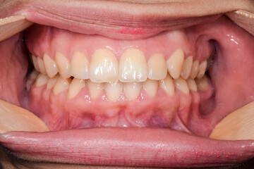 Front view of dental arches in occlusion, lips and cheeks retracted with four wooden tongue...
