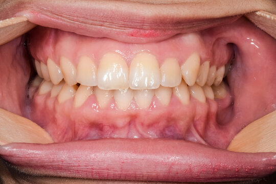 Wooden Tongue Depressor Stock Photo - Download Image Now - Tongue Depressor,  Cut Out, Tongue - iStock