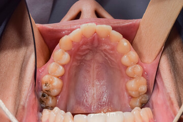 Occlusal view of a young woman maxillary arch, palate and nose, healthy teeth with some black stain on molars. Indirect view with dental mirror, lips and cheek retracted with wooden tongue depressors. © MSC