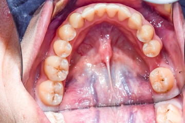 Occlusal view of a young woman mandibular arch with tongue retracted and healthy teeth with some black stain and a missing molar extracted. Indirect view with dental mirror, lips and cheek retracted. © MSC