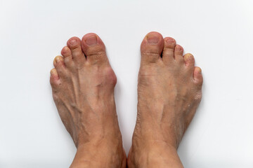 A foot with a gout bunion compared with a normal one not affected by the condition isolated in...