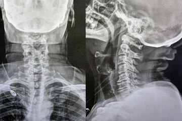 Plain X ray cervical vertebrae showing straightening of cervical vertebrae denoting muscle spasm and mild to moderate spondylosis from c3 3rd cervical vertebra to c6 6th cervical vertebra