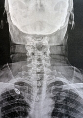 Plain X ray cervical vertebrae showing straightening of cervical vertebrae denoting muscle spasm...
