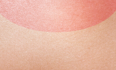 Sonnenbrand -  sunburn