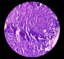 Suppurative cholecystitis of Gallbladder, show perimuscular fibrosis and dense infiltration of...