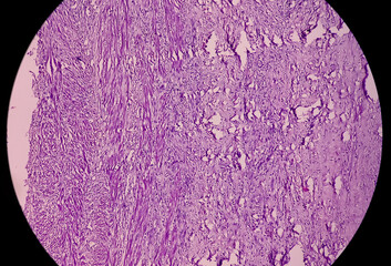 Suppurative cholecystitis of Gallbladder, show perimuscular fibrosis and dense infiltration of...