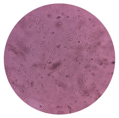 Budding yeast cells and calcium oxalate crystal in urine, urinary tract infections, analyze by...