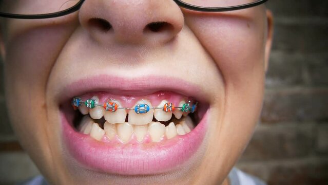 Young boy with orthodontic metal braces on teeth.  Abnormal teeth position concept