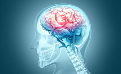 Human brain injury,damage,hemorrhage. 3d illustration