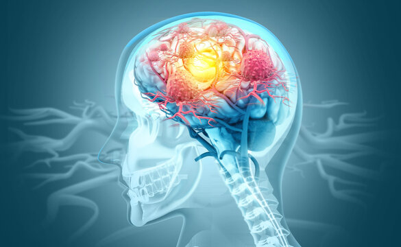 Cancer cells attacking a human brain. 3d illustration