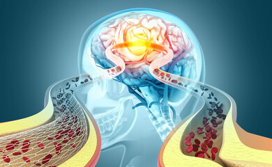 Stroke, stent angioplasty, blood stream, Damaged brain. 3d illustration